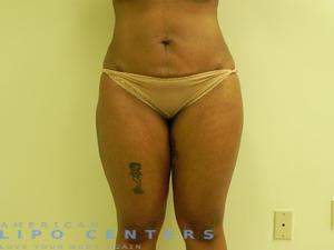 americanlipocenters_159.jpg